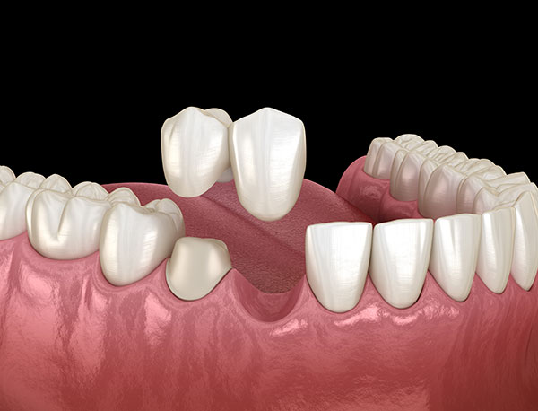 illustration of dental bridge on one supporting tooth